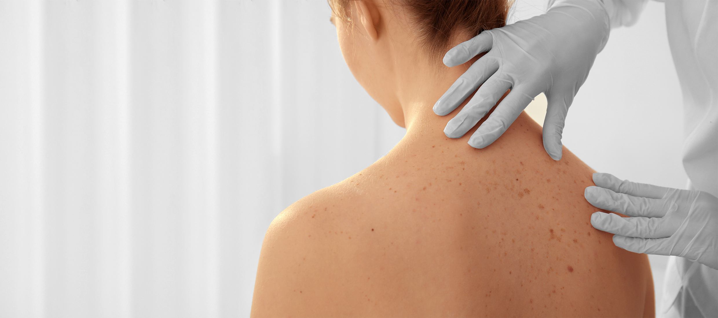 Dermatologist examines freckles and birth marks on a female patient's back